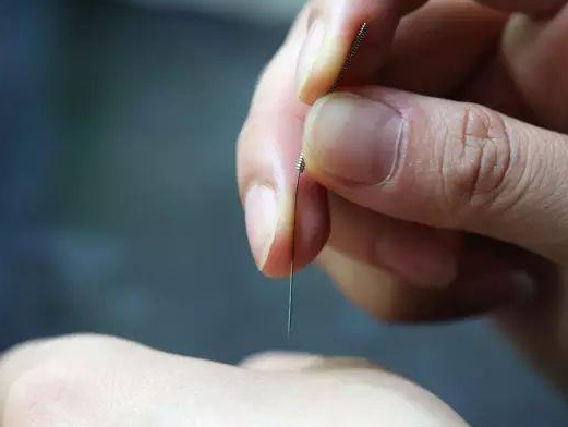 三棱針療法治療高燒嗎？